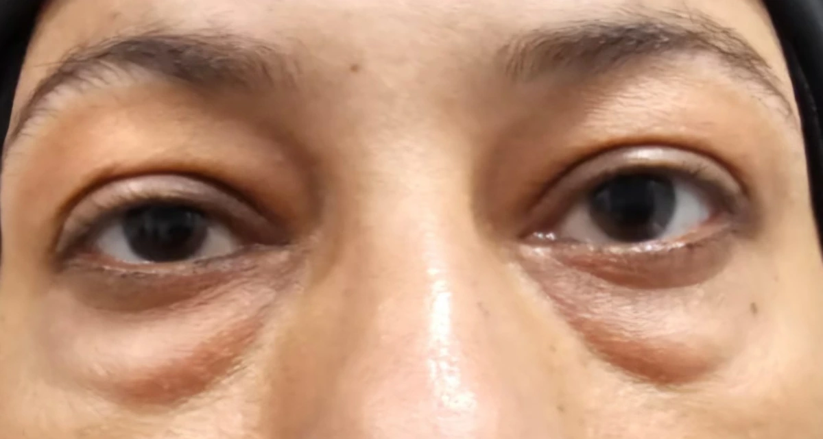 حالة تجميل الجفون قبل الإجراء